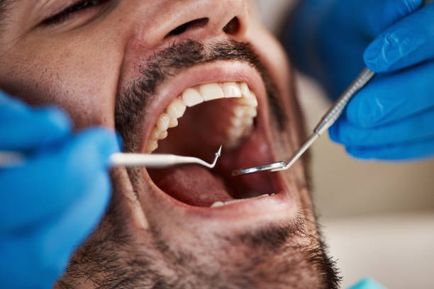 Best Root Canal Treatment  in Key Center, WA